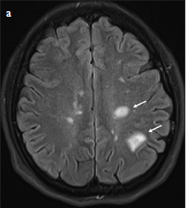 Is It Possible to Discriminate Active MS Lesions with Diffusion Weighted Imaging?