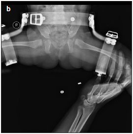 Comparison of Open Reduction Alone and Open Reduction Plus Pemberton Osteotomy Techniques in the Treatment of Developmental Hip Dysplasia at Walking Age