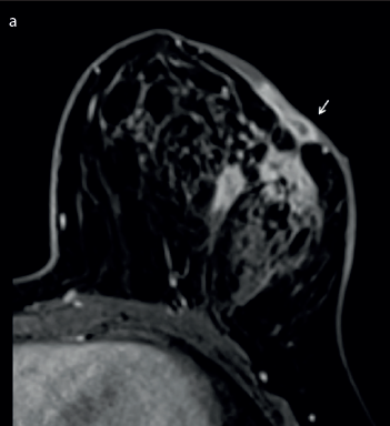 Diagnostic and Interventional Radiology in Idiopathic Granulomatous Mastitis