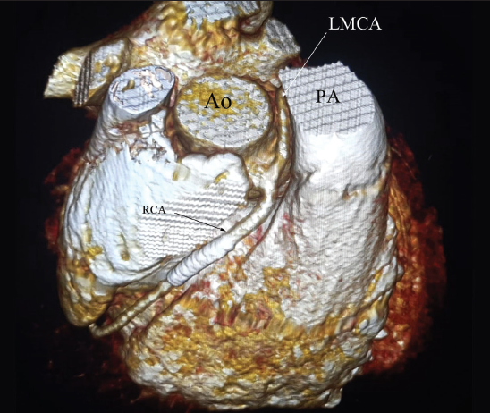 Percutaneous Coronary Intervention in A Rare Case of Single Coronary Ostium Presented with ST Elevation Myocardial Infarction