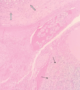Contralateral Testicular Metastasis of Renal Cell Carcinoma: A Case Report