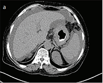 The Relationship of SUV Value in PET-CT with Tumor Differentiation and Tumor Markers in Gastric Cancer